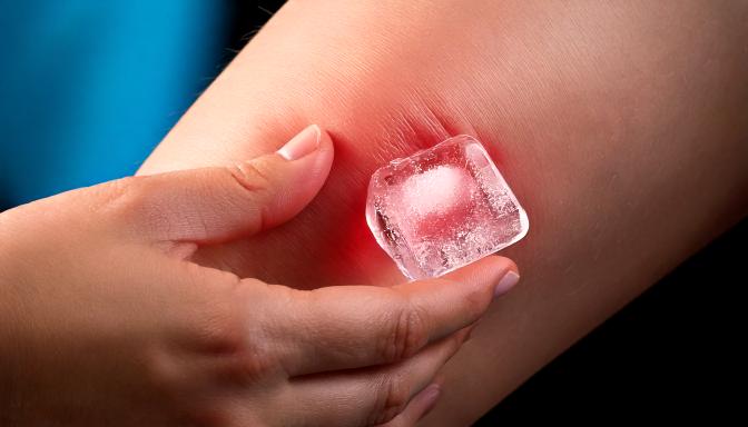 Hielo para Alivio en quemaduras, picaduras e inflamaciones